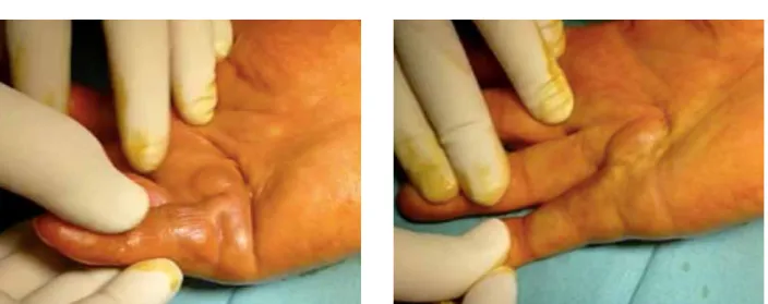 Figure 1A and 1B.   Between 24-48 hours after injection of collagenase, the finger is extended in order to facilitate cordal  rupture