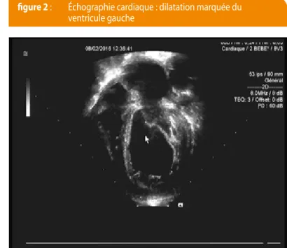 figure 1 :   Radiographie du thorax de face démontrant 