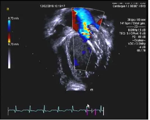 figure 3 :    Doppler couleur : insuffisance mitrale majeure