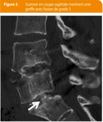 figure 3 :   Scanner en coupe sagittale montrant une  greffe avec fusion de grade 3