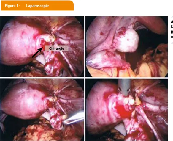 Figure 1 :   laparoscopie A - c - d. Rupture cornuale  Droite B. Annexe Gauche  normale chirurgie