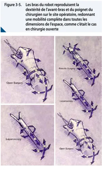 Figure 6-7.  Les mouvements réalisés par le chirurgien  à la console de commande du robot sont  miniaturisés et reproduits avec une précision  extrême par les instruments chirurgicaux  dans l’abdomen du patient