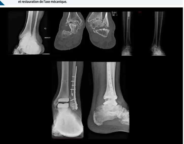 Figure 1.  Patient présentant une importante arthrose tibio-talienne avec déviation en valgus de l’arrière pied et trouble  statique majeur