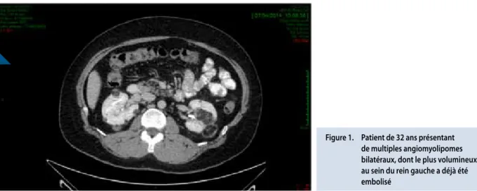 Figure 1.  Patient de 32 ans présentant  de multiples angiomyolipomes  bilatéraux, dont le plus volumineux  au sein du rein gauche a déjà été  embolisé