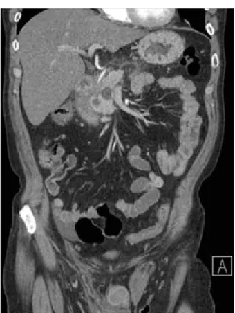Figure 1.  CT abdominal, coupe coronale : permettant de mettre  en évidence les collections au niveau des canaux  inguinaux et du scrotum.