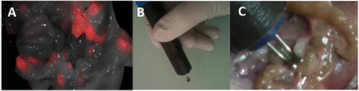 Fig. 2. Electrochemotherapy guided by intraoperative fluorescence imaging. A) Visualization of metastases by intraoperative fluorescence imaging 24 h after intravenous injection of Angiostamp®700