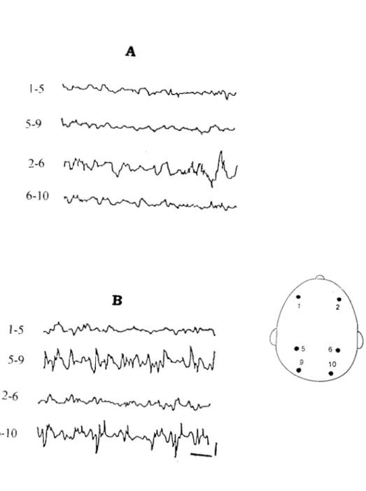 Figure 10 : Tracés EEG de veille chez deux sujets trypanosomés en phase méningo-