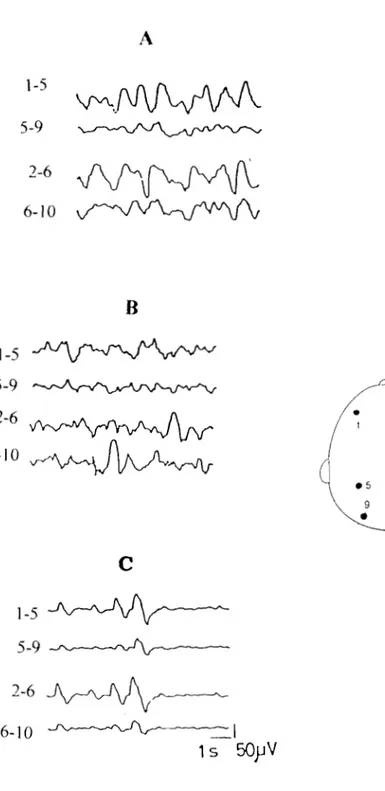 Figure 11 : EEG de veille chez des sujets trypanosomés en phase  méningo-encéphalitique montrant des ondes delta  monomorphes