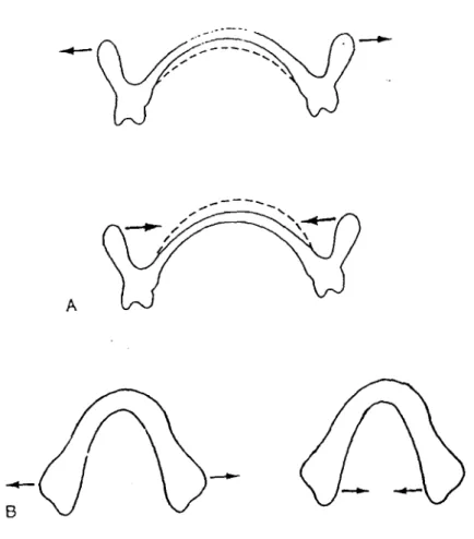 Fig 1. Shéma des différents types de défonnation des prothèses complètes maxillaires (A) et mandibulaire (8) (d'après