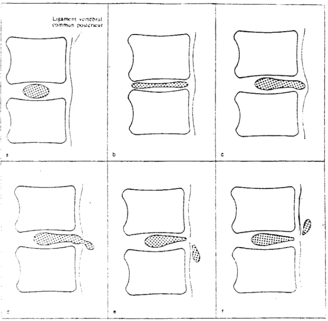 FIG  2  Coupe  sagittale  :  Classification  de  DELCOUX  des  hernies  discales  (  d'après  MANELFE  ) 