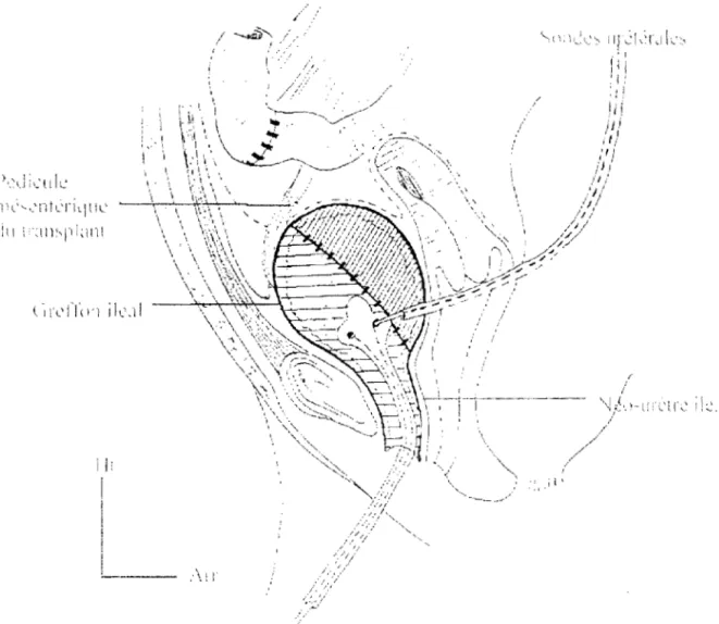 Fig. 8  :  lIéo-urétro-cyctopJastie  selon  Letac et  Barroux  Coupe sagittale  du  petit bassin  chez la  femme 