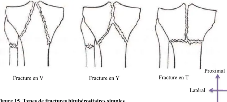 Figure 15. Types de fractures bitubérositaires simples  Type II : complexes 