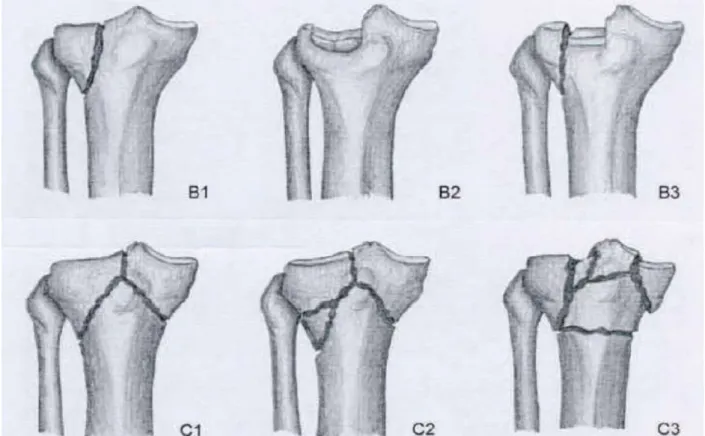 Figure 20. Classification de l’AO simplifiée des fractures du plateau tibial. 