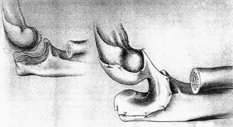 Figure  25 : Arthroplastie remodelante+ interposition ( d’après Morrey [25] ) 