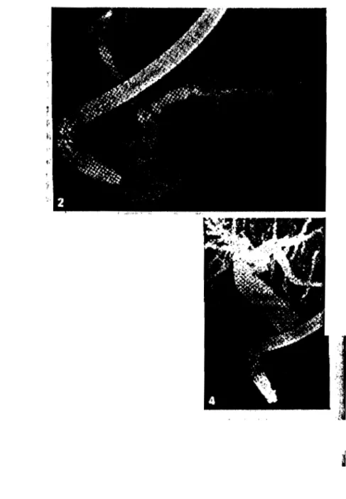 Figure  5  ;  Aspects  pancréatographique  et  cholangiographique  drun  cancer  de  la  tête  du  pancréas  (d'après  SAHEL  [32])