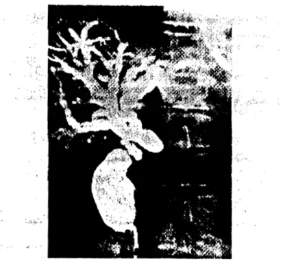 Figure  7  :  Aspect  cholangiographique d'un cancer céphalique:  dilatation  importante de la  VBP au-dessus  d'un obstacle infranchissable [22]