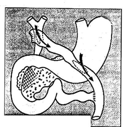 Figure  9  :  Double dérivation  bilio-digestive et  gastro-jéjullale sur  une anse en  Y  [9] 