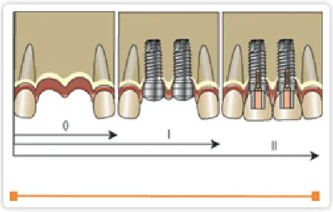 Figure  19:  schéma  illustrant  les  étapes  du  traitement  implantaire  en  un seul temps chirurgical