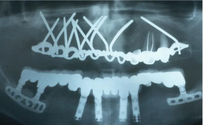 Figure  1:  les  différents  types  d’implants  dentaires :  implants  aiguilles,  cylindriques, cylindriques stabilisés