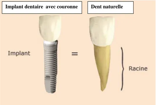 Figure  9 :  la  dent  naturelle  et  l’implant  dentaire.  wwwnatuerlich- wwwnatuerlich-attraktiv.ch  