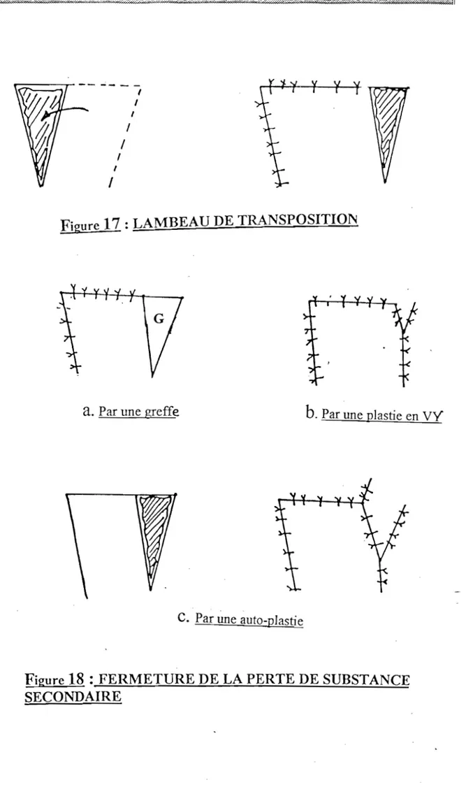 Figure  17 :  LAMBEAU DE TRA.NSPOSITION 