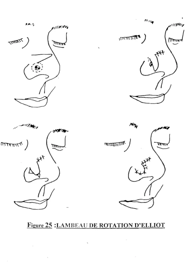 Figure 25  :LAJVIBEAU DE  ROTATION D'ELLIOT 