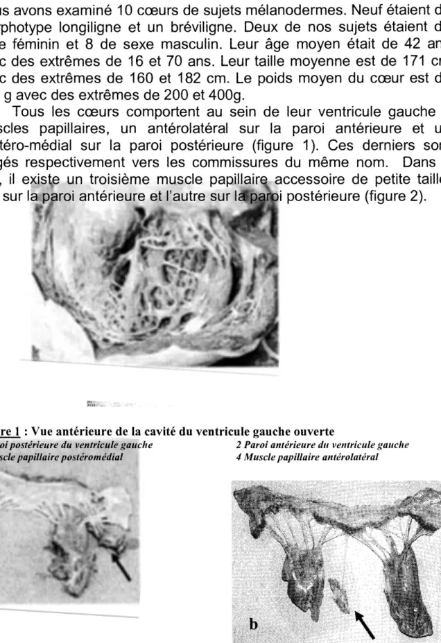 Figure 1 : Vue antérieure de la cavité du ventricule gauche ouverte 