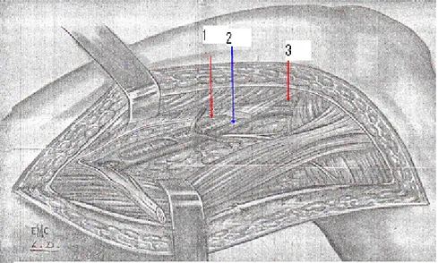 Figure 8 : Abord de l’artère poplitée haute [84] 