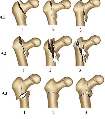 Figure 8 : classification d’AO Muller. 