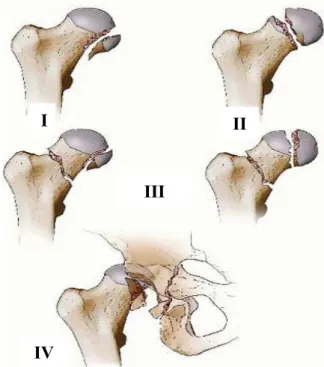 Figure 9 : classification de Pipkin. 