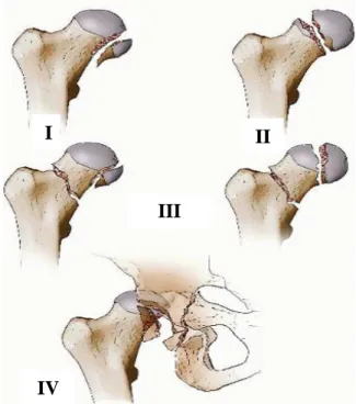 Figure 9 : classification de Pipkin. 