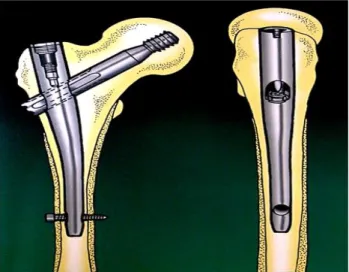 Figure 13: Clou gamma. (AO Surgery  Reference - AO Foundation). 