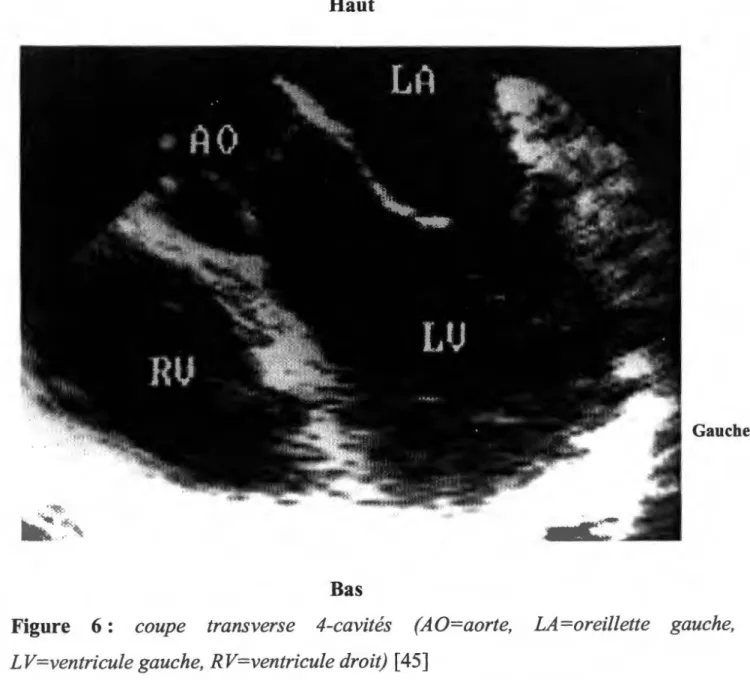Figure  6:  coupe  transverse  4-cavités  (AO=aorte,  LA=oreillette  gauche,  LV-ventricule gauche, RV  ventricule droit)  [  45] 