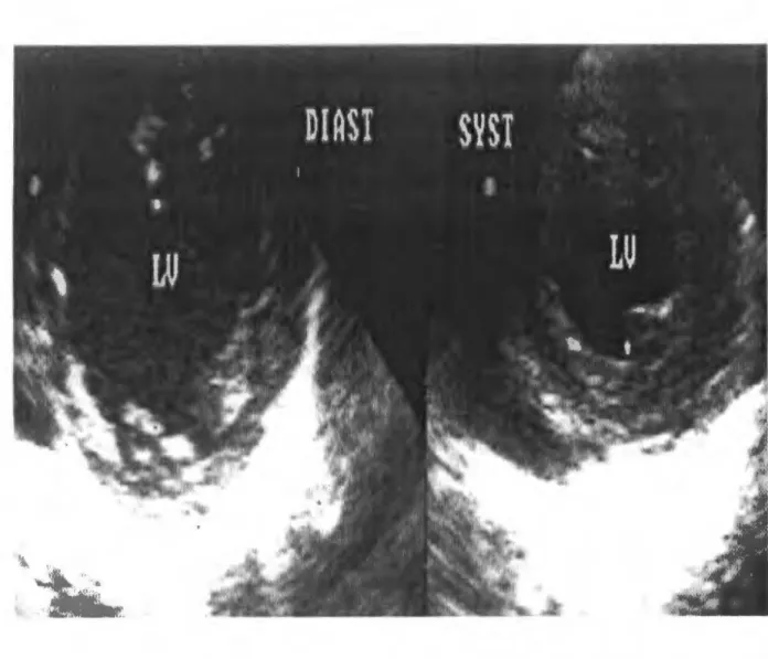 Figure  9 :  Coupe  transgastrique  petit- axe  visualisant le  ventricule  gauche  (LV)  en  systole et en diastole [ 45] 