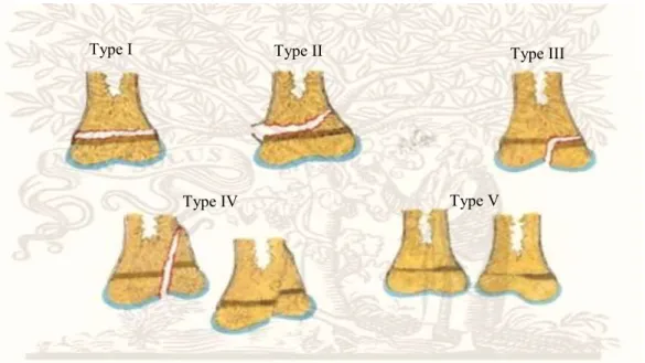 Figure 3: Classification de Salter Harris    B.  Eléments diagnostiques 