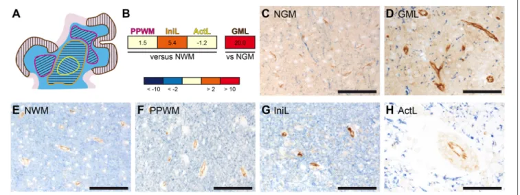 FIGURE 1 | Gene and protein expression of PECAM-1 is pronounced in initial white matter MS lesions and active cortical MS lesions