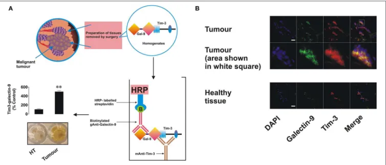 FIGURE 2 | Expression, interaction, and co-localization of Tim-3 and galectin-9 in primary human breast tumors