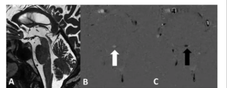 FIGURE 1 | Normal aqueduct with even width in a 70-year-old male subject on the sagittal 3D T 2 w TSE DRIVE sequence (A)