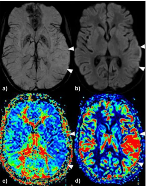 Fig. 1 22-year-old woman with MELAS syndrome and acute global aphasia. a In SWI  pseudo-diminished cortical veins are seen temporal left