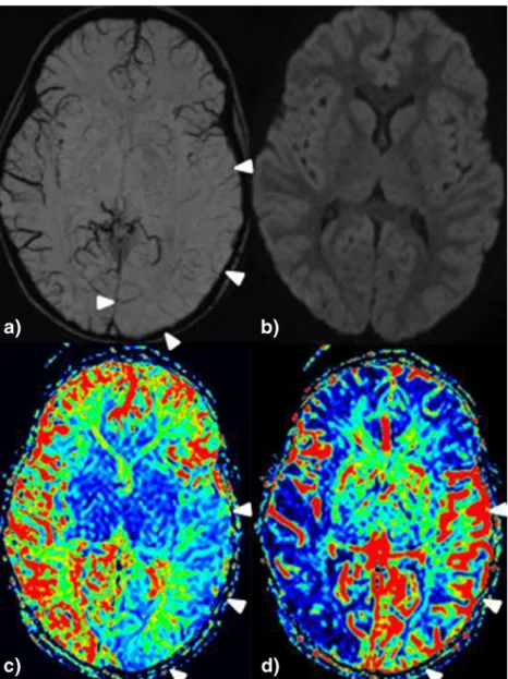 Fig. 2 4-year-old girl with fever seizure and clinical status epilepticus. a Pseudo-narrowed or pseudo-diminished cortical veins are found temporal-parietal and occipital left without diffusion restriction (b, but hyperperfusion in MTT (shortened) and rCBF
