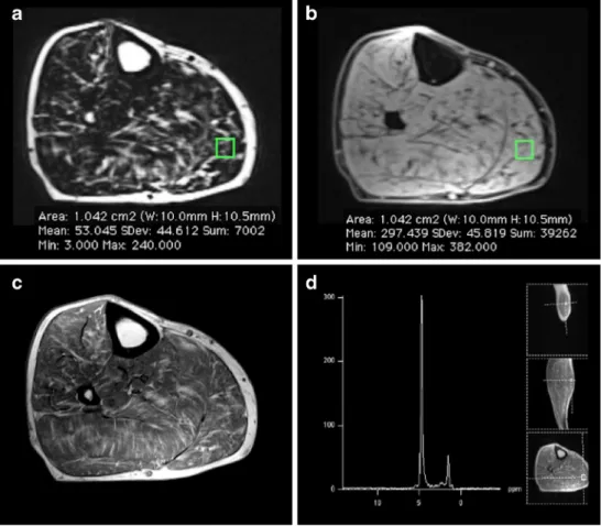 Fig. 2 In vivo measurement of fat-fractions derived from 2-point Dixon gradient-echo MRI (FF DIXON ) and MR-spectroscopy (FF MRS ) in a 77-year-old male patient with achillodynia.