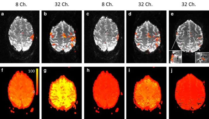 Fig. 1 a–e Activation maps of representative subjects. a Activation map acquired with the 8-channel coil, spatial resolution 1.3 mm 3 , 2 mm smoothing