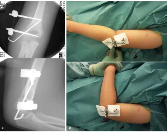 Abb. 21  8  Endkontrolle der Stabilität sowie der radiologischen und klinischen Achsen. Abschließende radiologische   Kontrolle im BV in Extension (a.-p.-Ebene) und Flexion (seitliche Ebene) sowie Dokumentation. Somit kann nochma- liges Röntgen postoperati