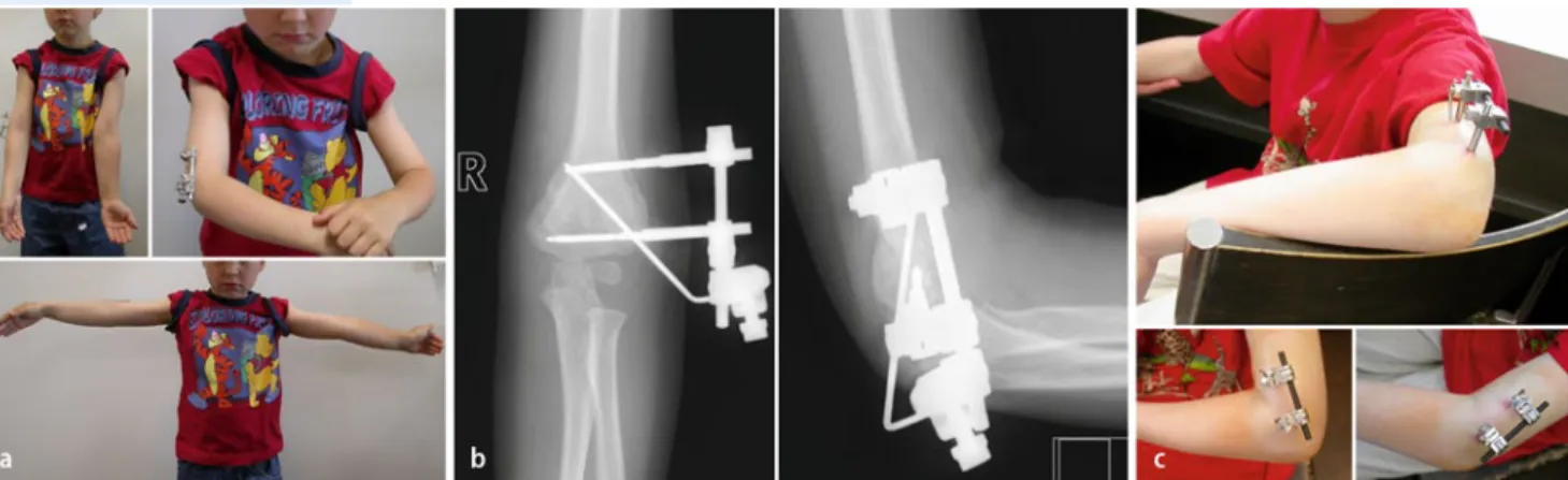 Abb. 22  8  Postoperatives Ergebnis. Klinische Situation mit bereits guter Beweglichkeit nach 7 Tagen bei starkem   Rückgang der Schwellung (kein Gips) und klinische Situation bei der Entfernung des Fixateurs mit entspannter Posi-tion und reizlosen Pin-Ste