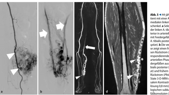 Abb. 5  9  44-jähriger Pa-  44-jähriger Pa-tient mit einer AVM am   medialen linken Unter-schenkel. a Selektive DSA   der linken A. tibilais pos-terior in arterieller Phase  mit Feedergefäßen aus der   A.  tibialis posterior (Pfeil- spitze). b Die venöse P