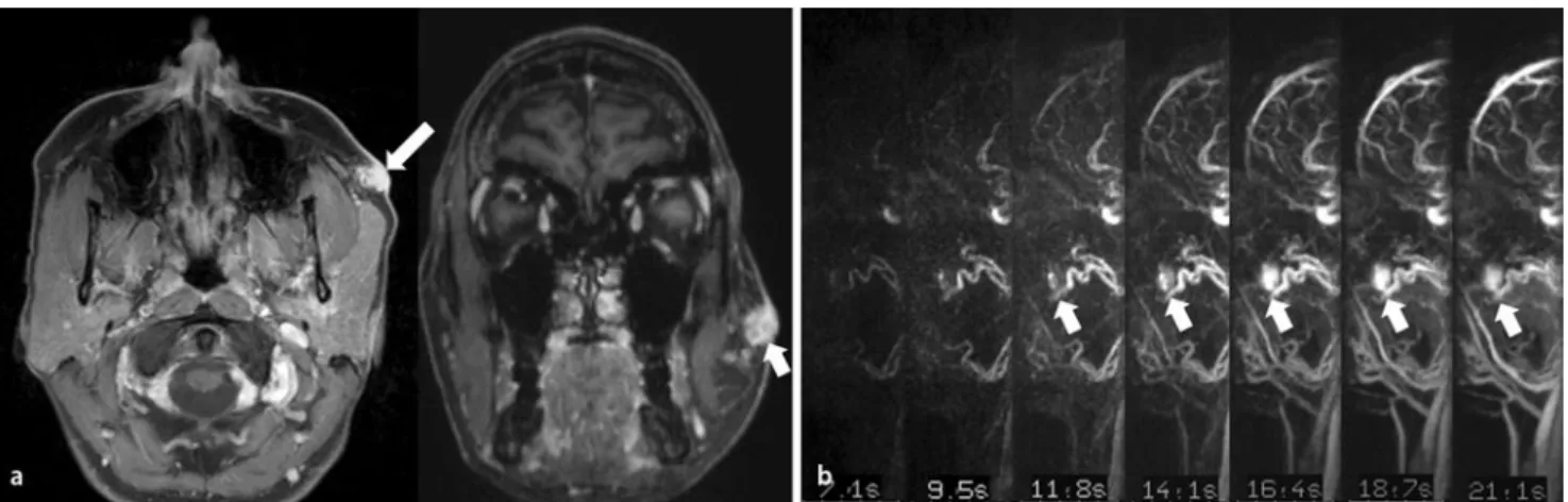 Abb. 6  8  37-jährige Patientin mit arteriovenöser Malformation der linken Wange. a MR-tomographisch in der T1-gewicht-  37-jährige Patientin mit arteriovenöser Malformation der linken Wange. a MR-tomographisch in der T1-gewicht-eten fettsaturierten Sequen