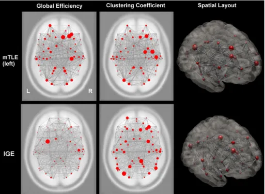 Fig. 1  Cortical functional networks in focal and generalized epilepsy  syndromes. This image shows two (qualitative) applied examples of  global integration and local segregation measures to cortical  func-tional networks in mesial temporal lobe epilepsy 