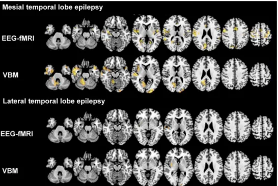 Fig. 3 Functional and structural networks in focal epilepsies. This  image illustrates the concordance between functional interictal  epi-leptic discharge (IED)-related networks derived from simultaneous  electroencephalography and functional magnetic reso