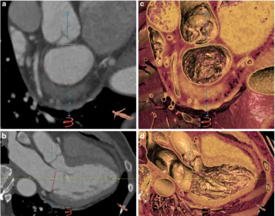 Fig. 2 Short axis (a and c) and long axis (b and d) reformation of the mitral valve in a healthy subject in 2D (a and b) and in 3D (c and d);