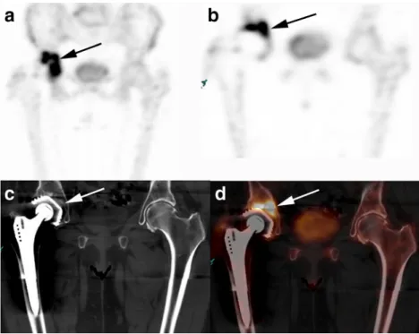 Fig. 3 A 27-year-old woman with pain in the left hip. MIP image (a) and coronal 99m Tc-DPD SPECT image (b) show focally increased tracer uptake (arrows) in the subtrochanteric region of the femur corresponding to an osteolytic lesion with central nidus on 